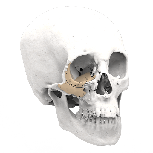 Orbital reconstruction Implant