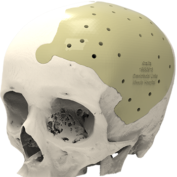 Cranial-implant