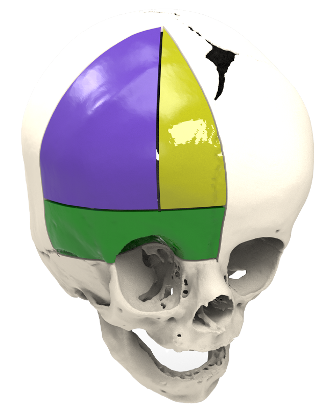 Craniosynostosis Infant Skull Reconstruction Planning