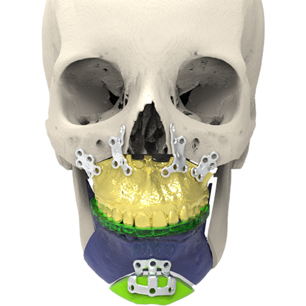 Custom Orthopedic Surgical Implants 3D Printed