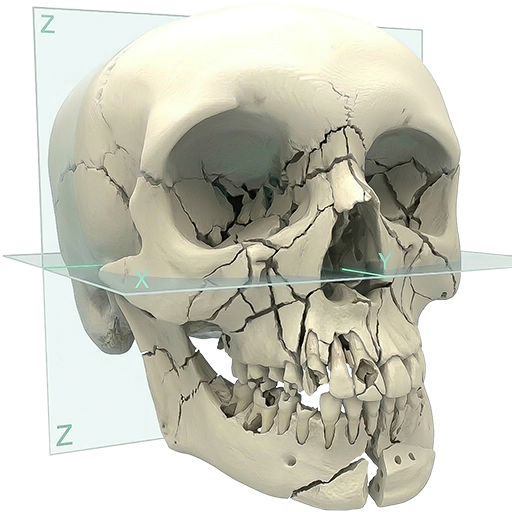 Virtual surgical planning for maxillofacial trauma