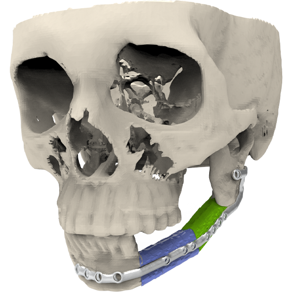 Free Fibula Flap Jaw Bone Reconstruction Guide