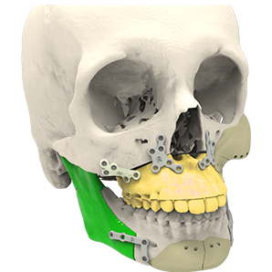 Maxillofacial-implant