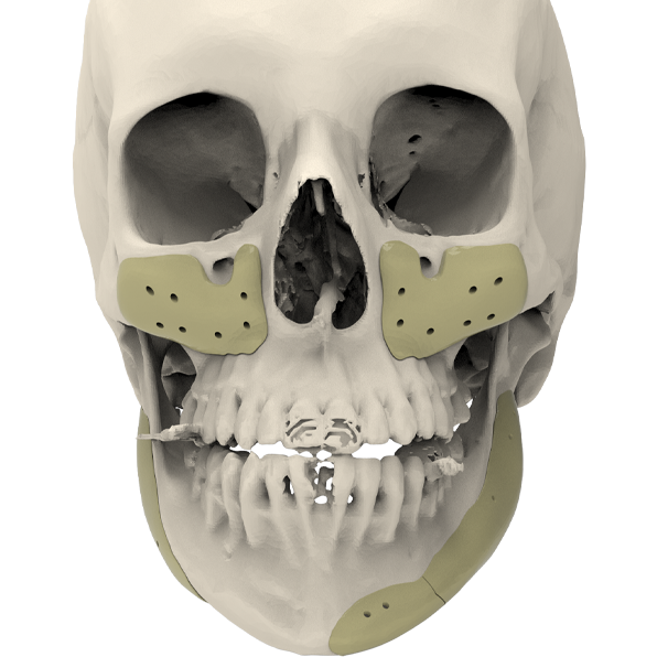 Cranial Reconstruction