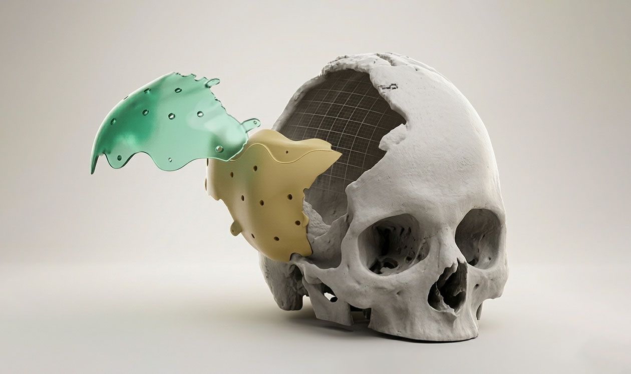 Patient-specific-design 