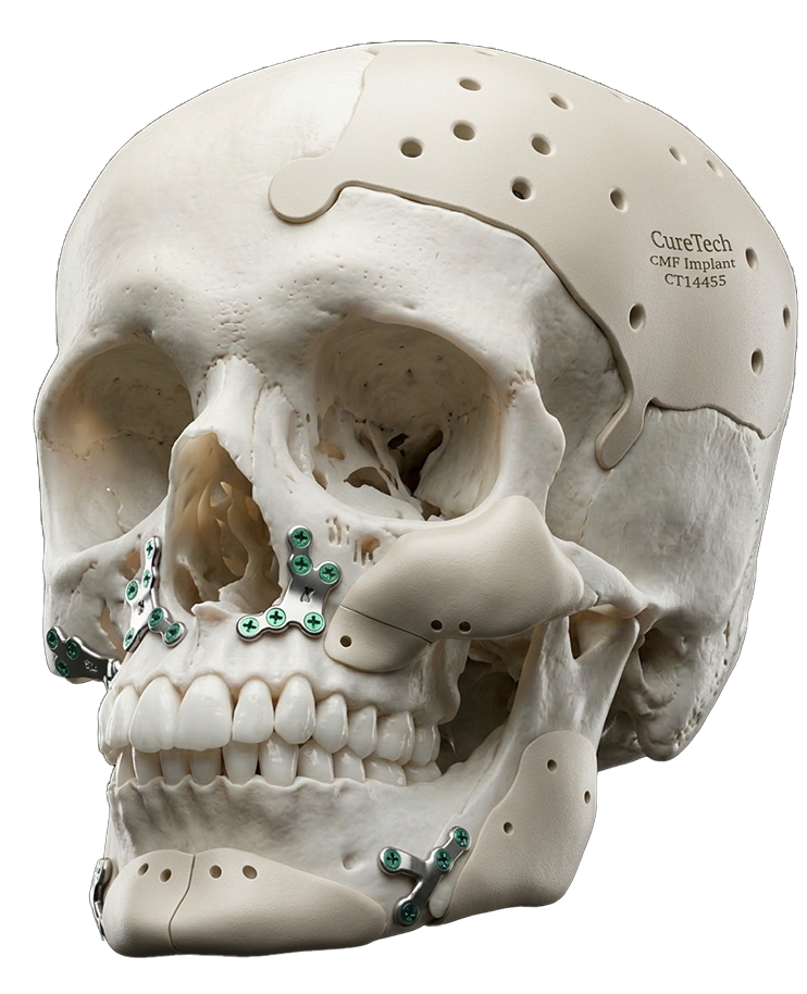 Custom cranio-maxillofacial implant model