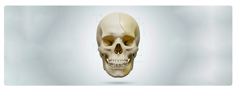 PEEK Patient-Specific Implants: The Gold Standard in Cranial Reconstruction