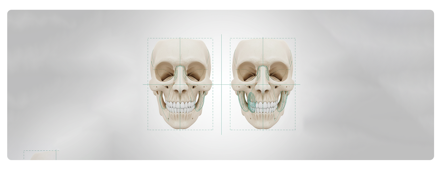Restoring Facial Symmetry: PEEK Solutions for Mandible and Midface Deformities